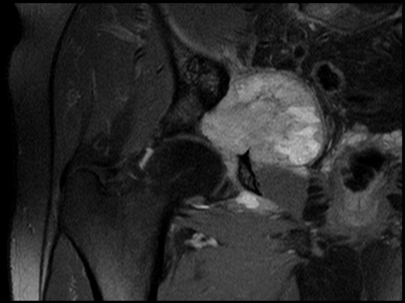 Fig 2. Coronal MRI showing acetabular tumour